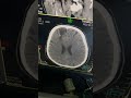 مفراس دماغ جلطه خثريه   