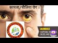 kamla rog (कामला/Jaundice) by aacharya charak (ch chi 16).