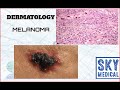 melanoma1