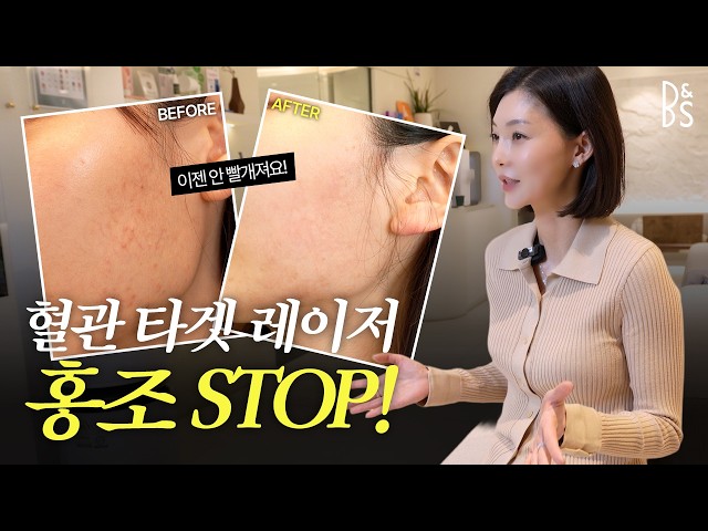 #혈관 부터 잡아야 사라진다 ‼️ 얼굴 #홍조 😡 #GV레이저 시술의 차이 🔎