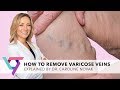 Medical Clinic: How To Remove Varicose Veins explained | Vein Treatment Center New York 10017