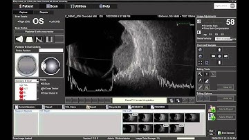 Performing 10MHz B-Scan with the Ellex Eye Cubed