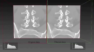 Open Inventor | Medical | Image Denoising: Bilateral Filter