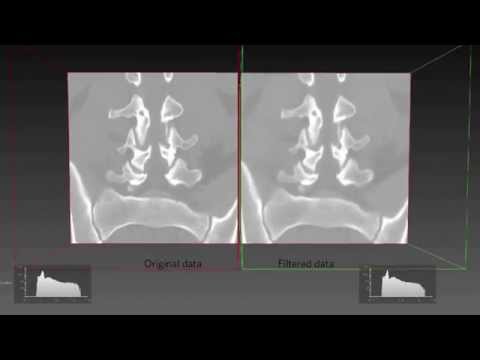 Open Inventor | Medical | Image Denoising: Bilateral Filter