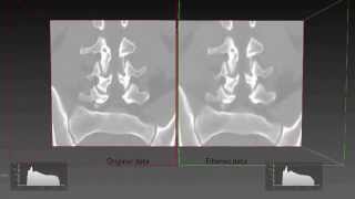 Open Inventor | Medical | Image Denoising: Bilateral Filter