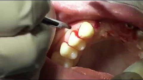 Block Bone Graft in upper jaw By Dr Amy Khajavi