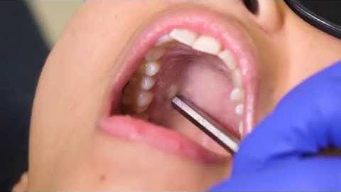 Greater Palatine Nerve Block Demonstration and Overview (4K)