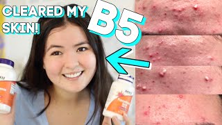 How I Cleared my Skin with Pantothenic acid B5 Acne Gone!