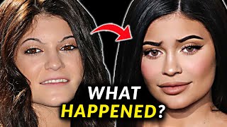 Kylie Jenner's Face - Before and After