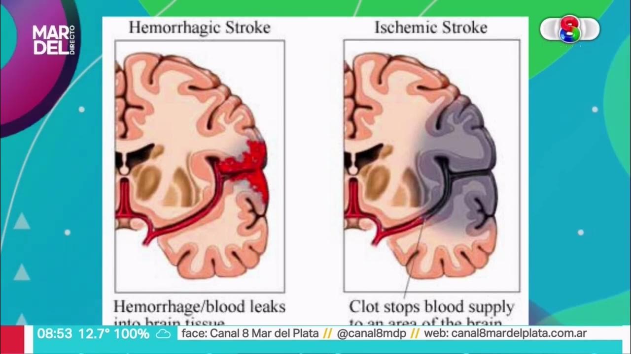 Рак после инсульта. Памятка по профилактике инсульта. Рак после инсульта. Инсульт симптомы. Кот инсульт мем.
