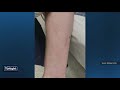 ‘It’s a miracle’: 17-year-old struck by lightning in Altamonte Springs shares his story