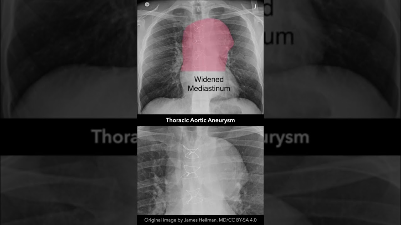 Thoracic Aortic Aneurysm Xray
