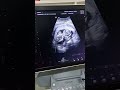 3 month  baby scan  my achu shorts