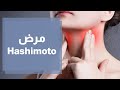مرض الـهاشيموتو  ما هي اعراضه وكيف يمكن معالجته