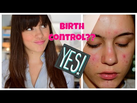 ⭐️ Starting Birth Control? Acne Upate!