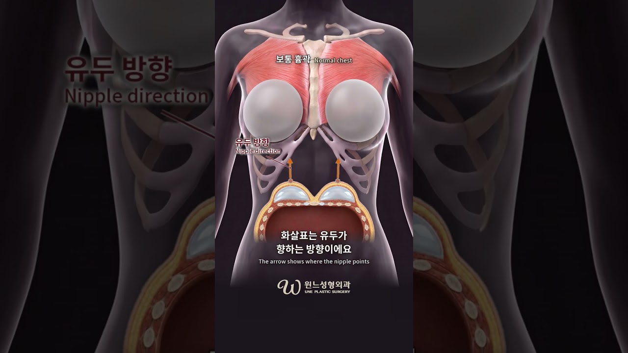 새가슴·오목가슴 가슴성형, 보형물은 어디를 향할까? #Shorts