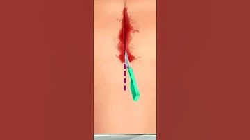 Hearts surgery bypass heart surgery 3d animation/#shorts