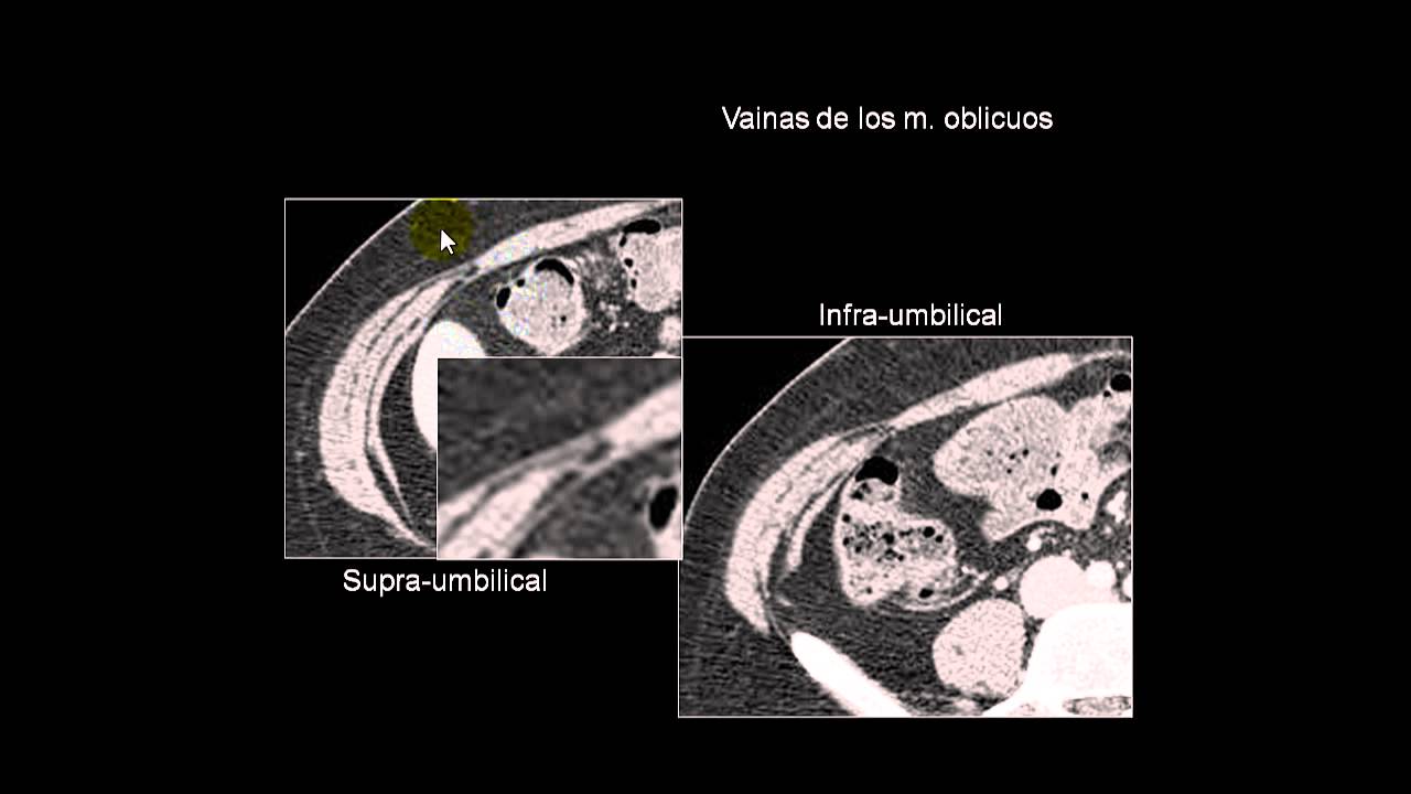 Paredes de abdomen en TC