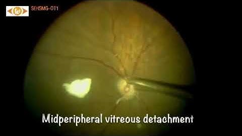 AIOCMTC4 2025 - VT64 - Dr.Hemanth Ramachandar - TECHNIQUES OF PVD INDUCTION IN CHALLENGING SCENAR...