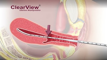 Manipulador Uterino ClearView®