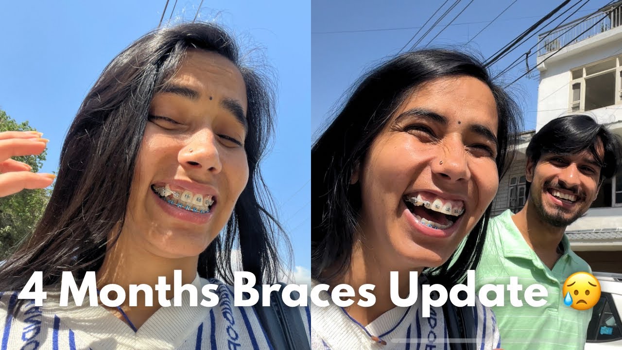4 months braces update / Wire tightening vlog bracesjourney braces 