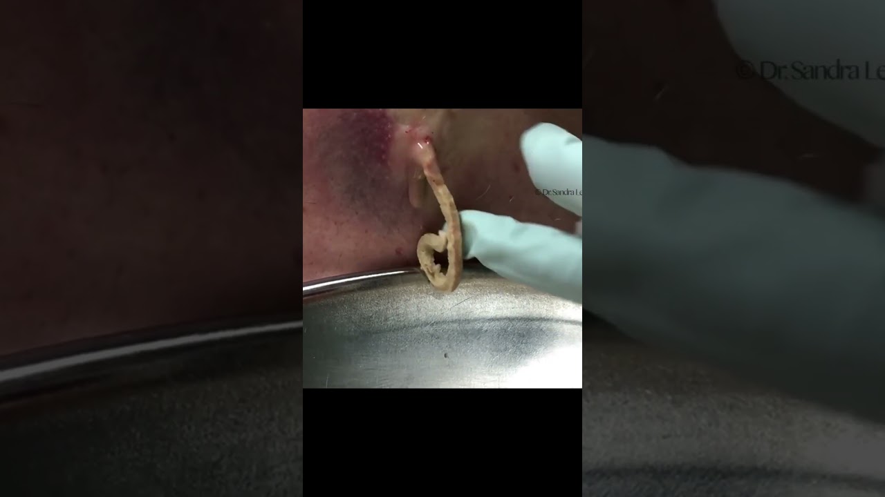 Raise your hand if you're abscessed! 🙋🏻&zwj;♀️😂 #drpimplepopper #popaholics #dermatology #pimplepopping