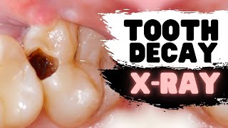 Tooth Decay On Dental X-Ray | Can You Spot The Cavity?