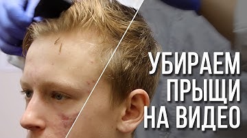 Убираем прыщи на видео | Ретушь портрета на видео | Remove acne on video | Mocha AE