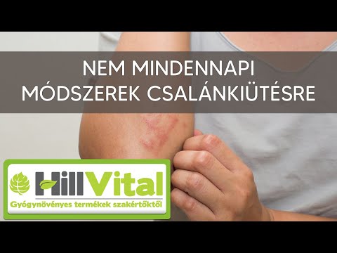 Videó: Hogyan kell kezelni a hideg csalánkiütést: 7 lépés (képekkel)