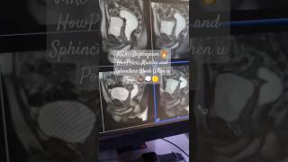 MRI Defecogram 🔥.. How pelvic muscles and Sphincters work when u POOP..💩🚽👀🤦#ytshorts #viral #health