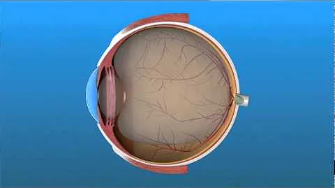 Vitrectomy Surgery for Detached Retina
