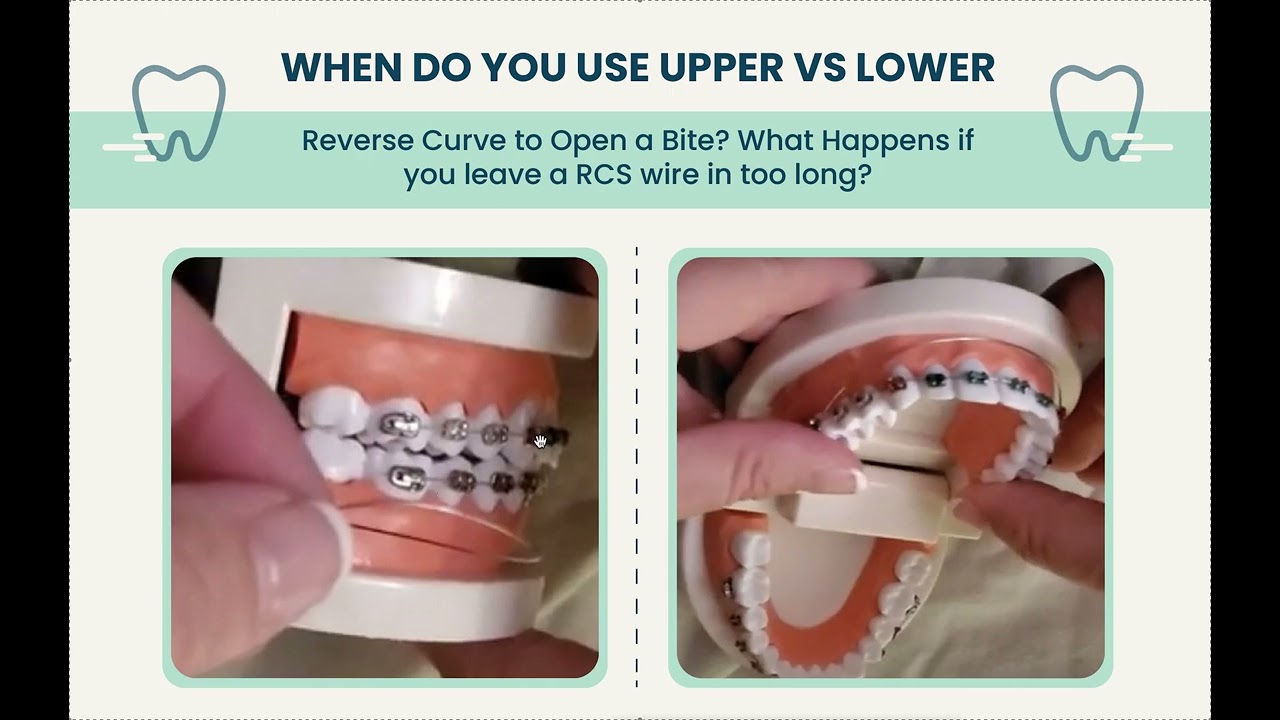 Reverse Curve Wire Dangers/ Upper vs Lower RCS Wires/ ACS Wires