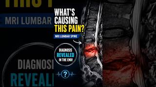Can You Diagnose This Spine MRI? | #Radiology #MRI #RadiologyShorts #SpineMRI#MedEd