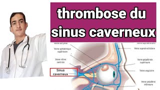 thrombose du sinus caverneux