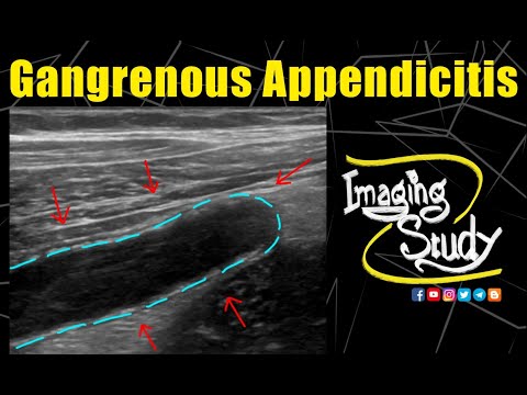 Video: Wat is gangreneuze appendicitis?