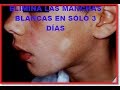 Manchas Blancas En La Cara