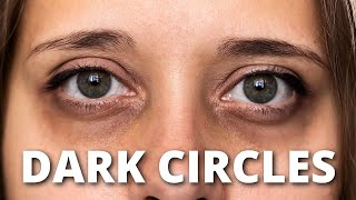 Get Rid of Dark Circles For GOOD with These Techniques
If you’re ready to finally understand what’s causing your dark circles and treat them with the right strategy... this video is for you.
Heres the real truth... Not all dark circles are caused by the same thing.
In this video, youll learn:
- The two main causes of dark circles (Pigmentation vs Vascular)
- How to do the 5-second Pinch Test at home to identify your type
- Which ingredients actually work based on YOUR dark circle cause
- How to combine products for faster, visible results
Whether your dark circles are brown, blue, or a little of both, you’ll finally know how to treat them the right way.
Let us know in the comments if your dark circles faded or stayed when you did the Pinch Test?
Join this channel to get access to perks:
https://www.youtube.com/channel/UCyK4n2FRJrLUhrj-oGcSOxw/join
Interested in becoming a sponsor in one of our videos? Email Storm at skinzonecollaborations@gmail.com
🎥 About this channel: We make free videos on skincare brands, skincare products and skin education. Subscribe for more: https://www.youtube.com/channel/UCyK4n2FRJrLUhrj-oGcSOxw?sub_confirmation=1
MUSIC:
Music from https://freetousemusic.com/
Track: Office by Aylex
https://www.youtube.com/watch?v=splsPiFeuEw&t=0s
FAIR-USE COPYRIGHT DISCLAIMER
* Copyright Disclaimer Under Section 107 of the Copyright Act 1976, allowance is made for fair use for purposes such as criticism, commenting, news reporting, teaching, scholarship, and research. Fair use is a use permitted by copyright statute that might otherwise be infringing. Non-profit, educational or personal use tips the balance in favor of fair use.
1) This video has no negative impact on the original works
2) This video is also for teaching purposes.
3) It is transformative in nature.
Disclaimer: This video is not intended to provide diagnosis, treatment or medical advice. Content provided on this Youtube channel is for educational purposes only. Please consult with a physician or other healthcare professional regarding any medical or health related diagnosis or treatment options. Information on this Youtube channel should not be considered as a substitute for advice from a healthcare professional. The statements made about specific products throughout this video are not to diagnose, treat, cure or prevent disease.
Affiliate Disclaimer: This description contains affiliate links in which I earn a small commission from if someone purchases through my link. You are not obligated to purchase through this link but if you do, I will receive a small commission. Thank you for supporting the SkinZone TV channel.
Copyright © 2024 - All rights reserved.
#darkcircles #darkcirclesundereyes #darkcirclescream
https://youtu.be/2aTOS-M4lqo Get Rid of Dark Circles For GOOD with These Techniques