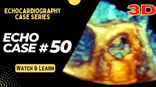 Echo Case 50: Echocardiography Spot Diagnosis Series - Cardiology - 3D Echocardiogram screenshot 5