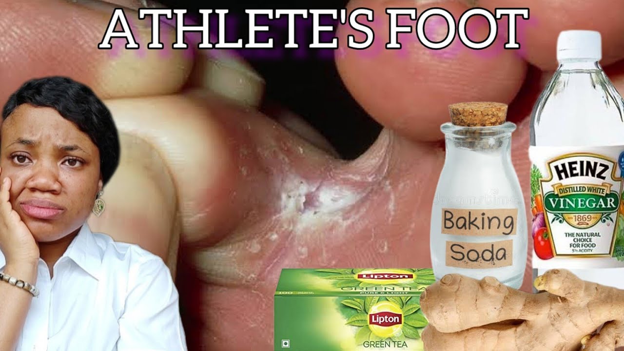 Get Rid Of Itchy Smelly Feet Use Baking Soda Ginger Vinegar Home get-rid-of-itchy-smelly-feet-use-baking-soda-ginger-vinegar-home