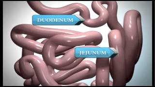 Roux en Y Educational Video - Bariatric Weight Loss Solutions - Ready 4a Change