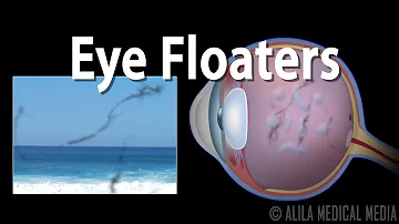 What is usually the first sign of glaucoma?