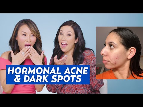 Hormonal Acne and Hyperpigmentation Skincare Routine for Giselle!