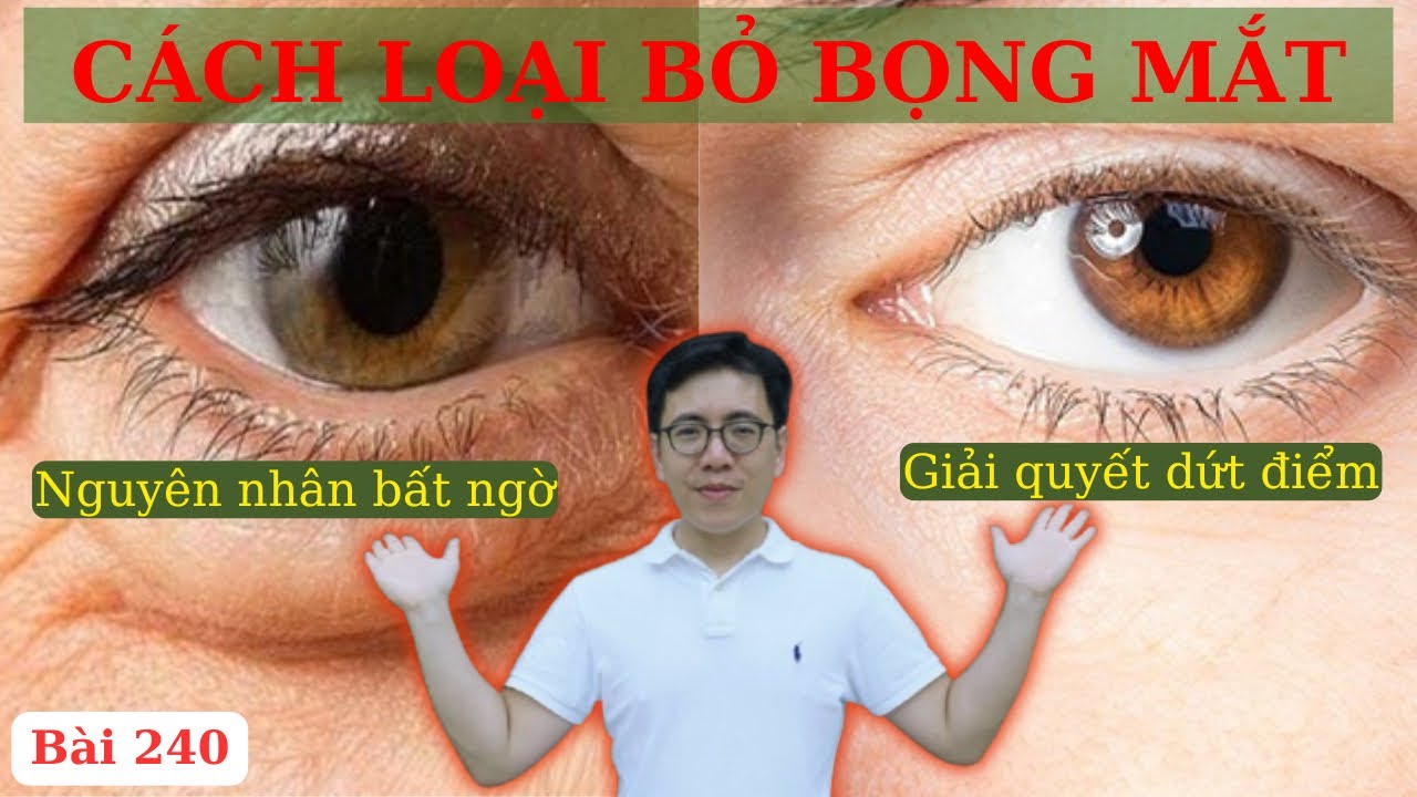 Cách LOẠI BỎ BỌNG MẮT, MẮT SƯNG HÚP bằng bí quyết vàng từ Ds Nguyễn Quốc Tuấn