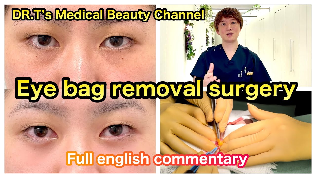 Eye bag removal surgery with full english commentary YouTube