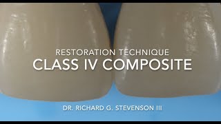 Class IV Composite Restoration | Restoration Technique