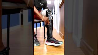 Cutting-Edge Prosthetics: 3D Printed Covers for BK Amputees