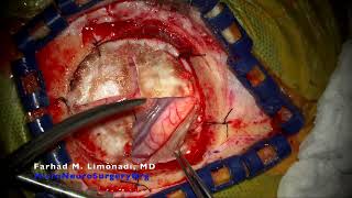 Brain tumor and awake brain surgery: Resection of metastatic melanoma