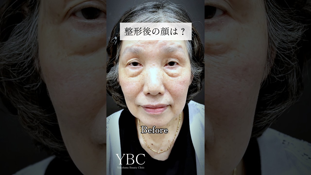 v*】様 【新品　定価以下格安】目の下のクマ治療 : 「動画・イラスト・写真」で YouTube