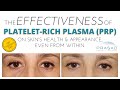 Effectiveness of Platelet-Rich Plasma (PRP) for Skin and Facial Rejuvenation