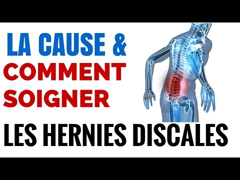 Vidéo: Hernie Séquestrée De La Colonne Vertébrale: Symptômes, Traitement, Causes